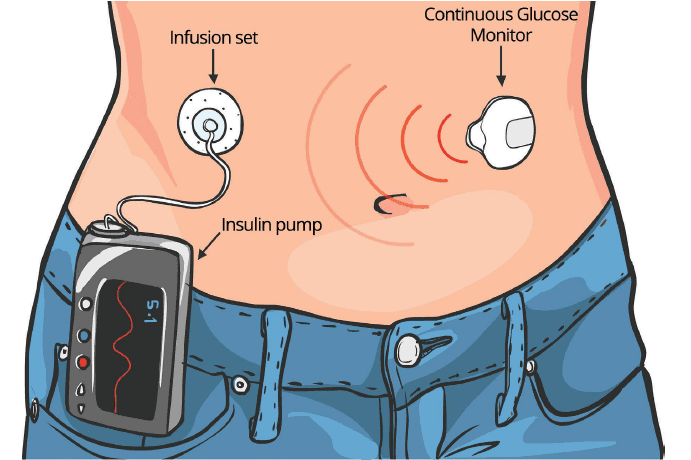 A person wearing a continuous glucose monitoring device